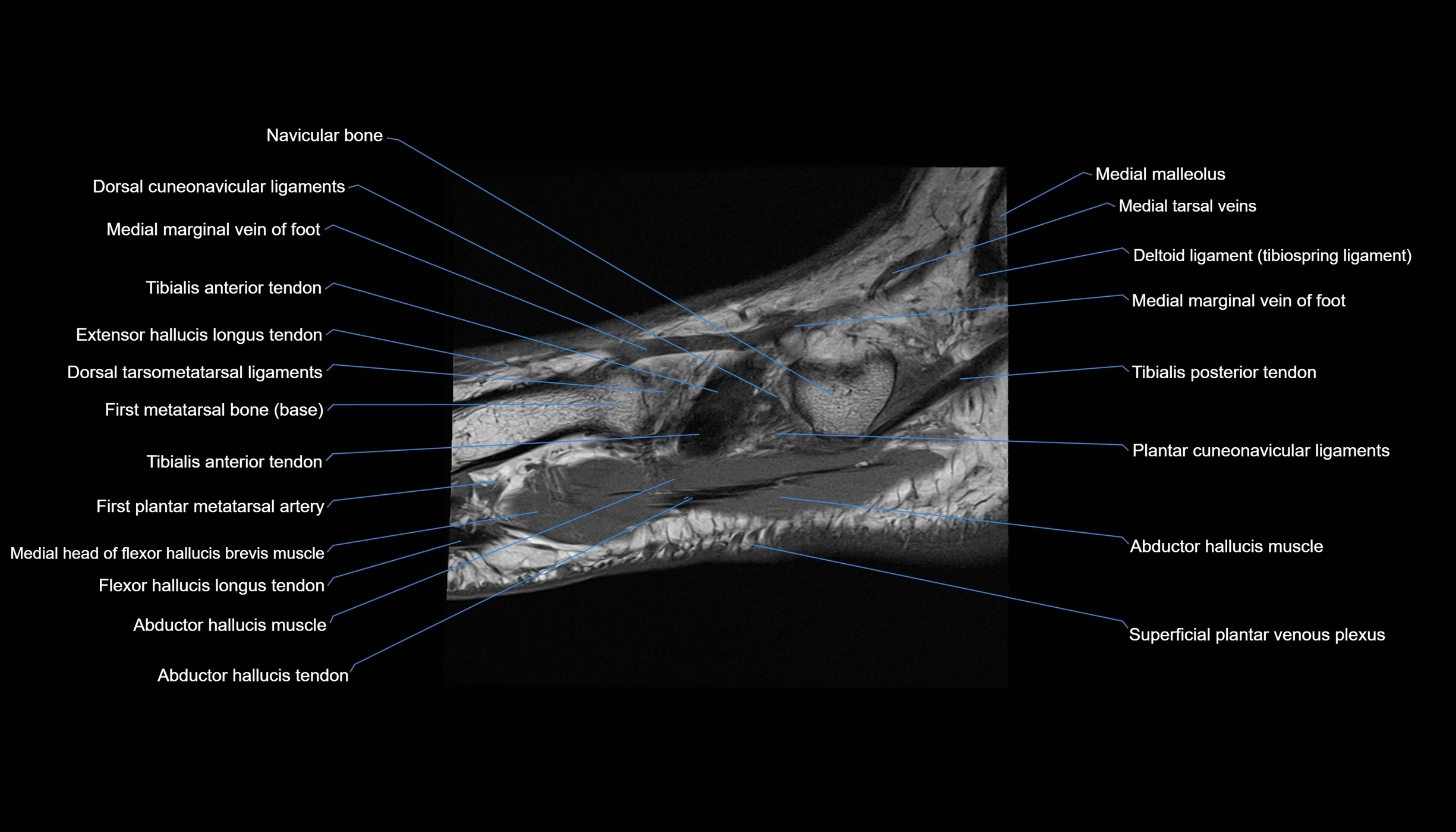 MRI mid foot sagittal cross sectional anatomy 3T  radiology  image-img-00001-00036.webp
